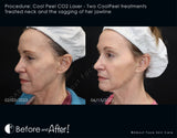 CoolPeel CO2 Treatment (Face and Neck)