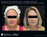 CoolPeel CO2 Treatment (Face and Neck)